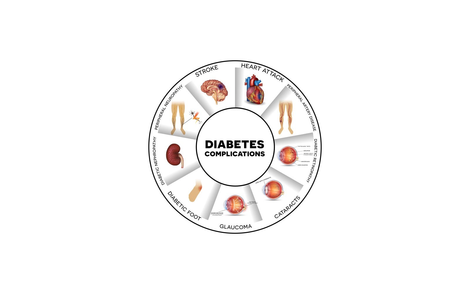 How Can Diabetes Trigger Stroke?